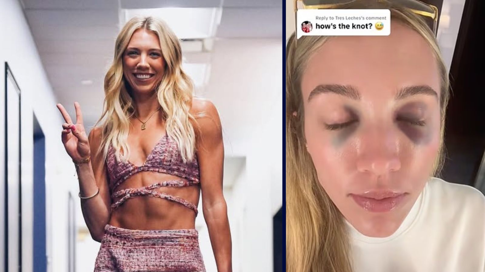 WNBA STAR LEXIE HULL SHOCKS FANS WITH ‘INSANE’ BLACK EYES AFTER NASTY COLLISION WITH RIVAL